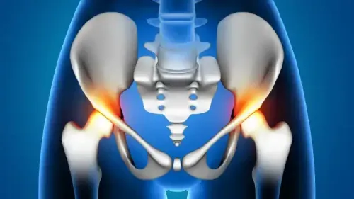 Pisotriquetral Osteoarthritis and Its Impact on Wrist Function
